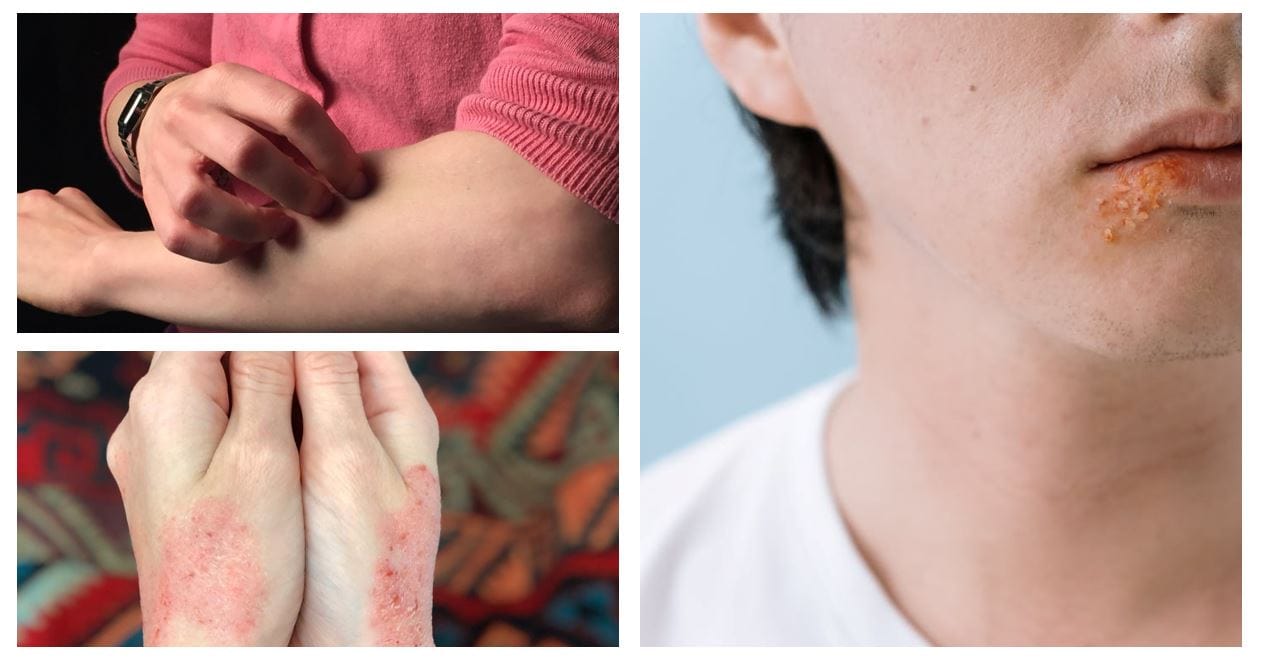 Read more about the article Choroby skóry – korzyści płynące z tlenoterapii. Komora hiperbaryczna w dermatologii